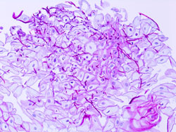 Esophageal candidiasis